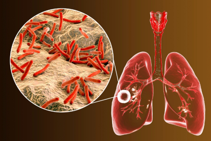 dia-mundial-de-la-tuberculosis imagen de artículo