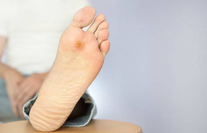 ulceras-del-pie-diabetico imagen de artículo