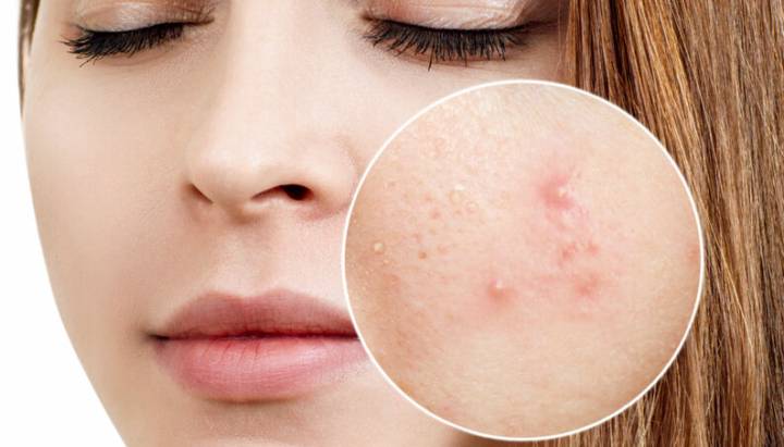acne-por-uso-de-mascarilla imagen de artículo