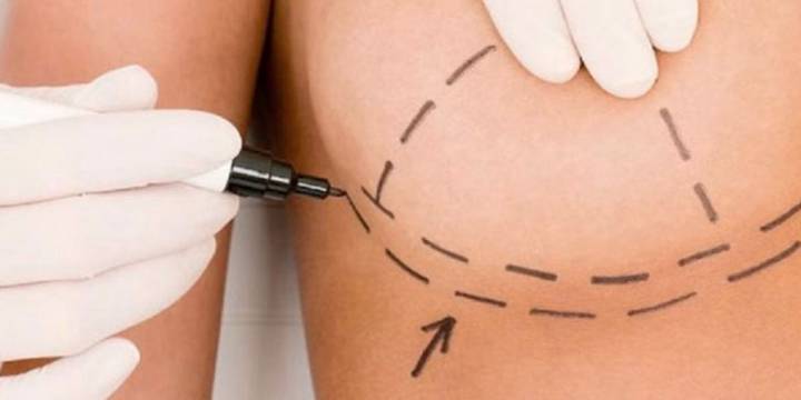lipotransferencia-de-proteccion-con-implantes-irradiados imagen de artículo