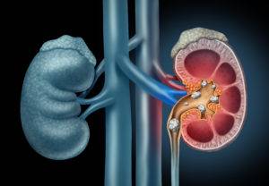litiasis-renal-y-de-las-vias-urinarias-en-pediatria imagen de artículo