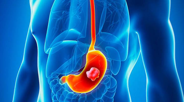 cancer-gastrico-avanzado-nuevos-agentes-de-acuerdo-a-un-estudio imagen de artículo