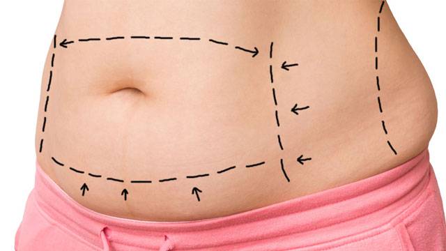 abdominoplastia-recuperar-un-abdomen-ideal imagen de artículo