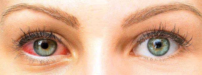 enfermedad-de-ojo-seco-sintomas-tratamiento-y-complicaciones imagen de artículo