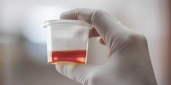 hematuria-sintomas-y-causas imagen de artículo