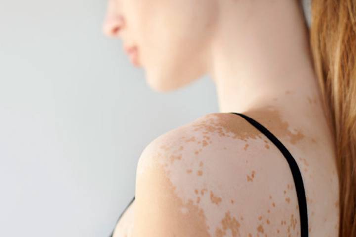 trastorno-de-la-piel-irreversible imagen de artículo