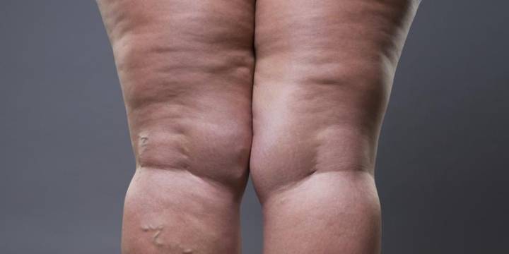que-es-el-lipedema-y-linfedema imagen de artículo