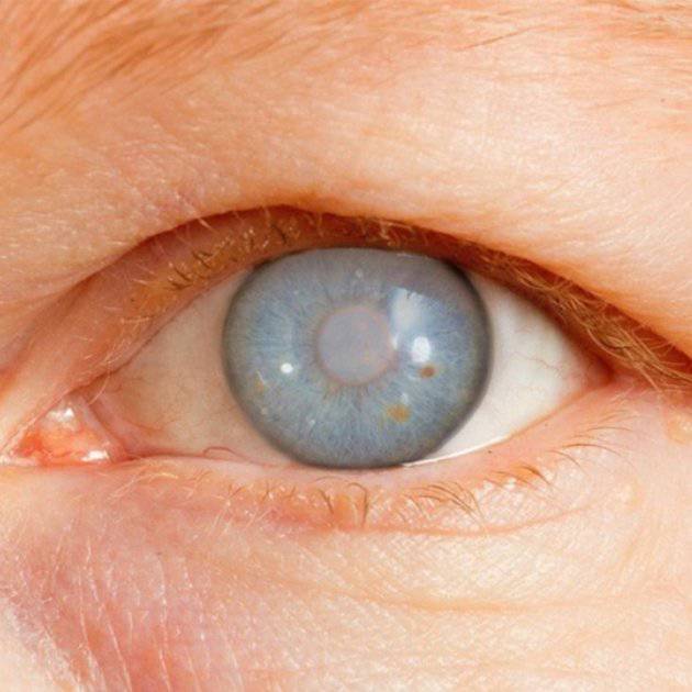 Glaucoma de Ángulo Abierto y sus posibles causas