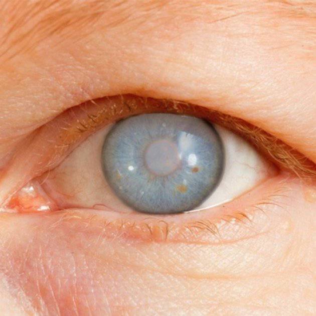 glaucoma-de-angulo-abierto-y-sus-posibles-causas imagen de artículo