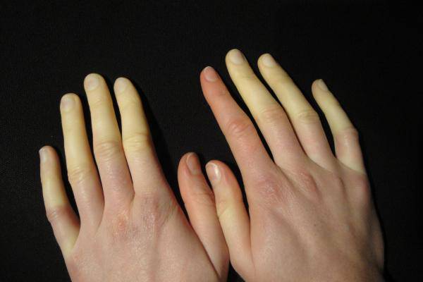 lo-que-no-sabes-sobre-el-fenomeno-raynaud imagen de artículo