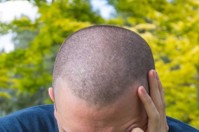 una-solucion-efectiva-para-aquellos-que-estan-perdiendo-el-pelo imagen de artículo