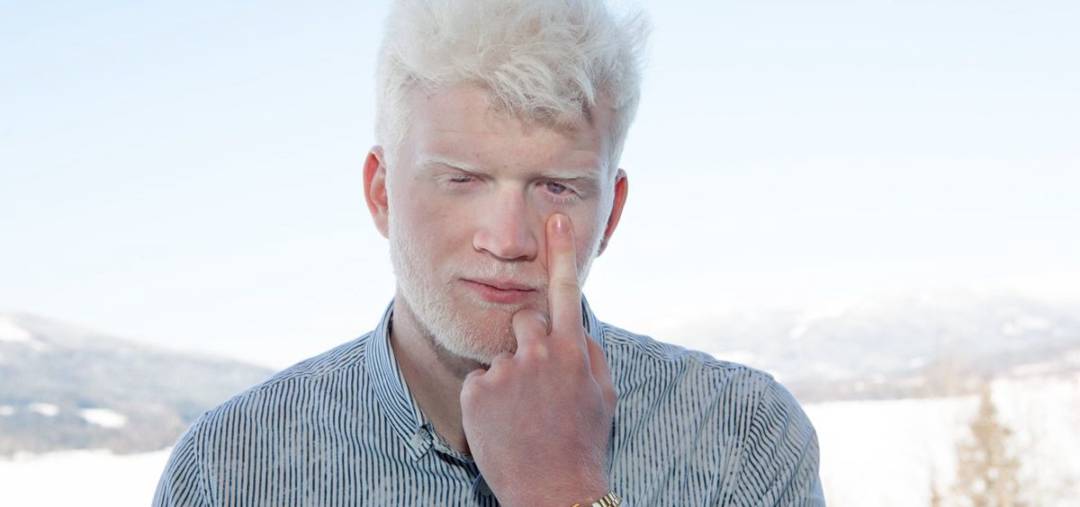 Albinismo: ¿cómo se vive con esta condición genética?