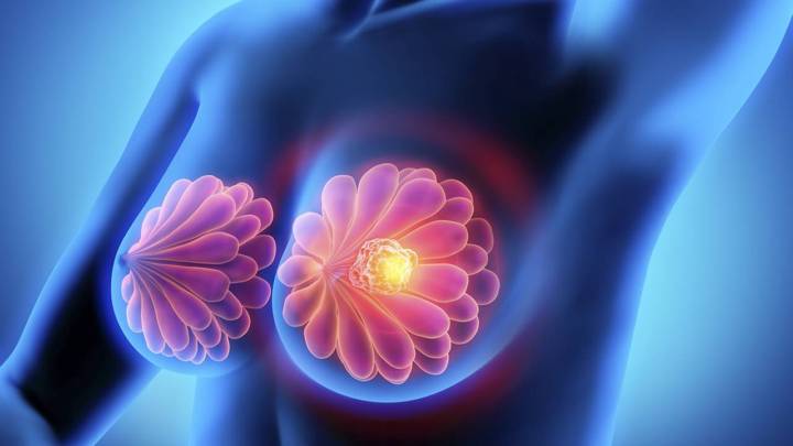 crean-virus-para-que-el-cancer-de-mama-se-destruya-a-si-mismo imagen de artículo