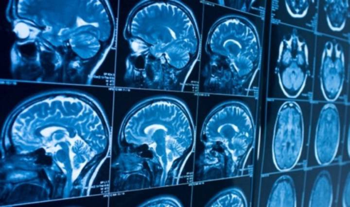 uno-de-cada-tres-recuperados-de-covid-19-tiene-problemas-en-el-sistema-nervioso imagen de artículo