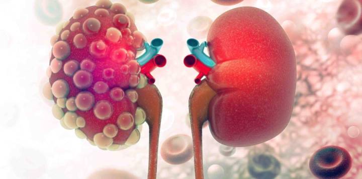 dia-mundial-del-cancer-de-rinon-el-tercer-tumor-maligno-mas-comun-en-el-aparato-urogenital imagen de artículo