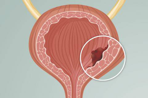 cancer-de-vejiga-causas-sintomas-tratamiento imagen de artículo
