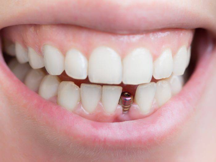 implantes-dentales-sin-dolor imagen de artículo