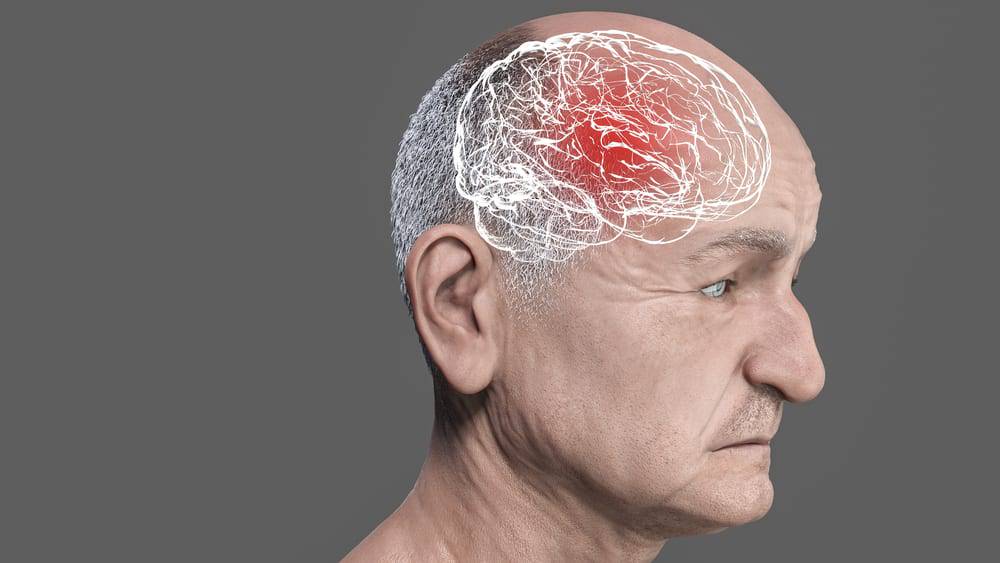 demencia-frontotemporal-una-rara-enfermedad imágen de artículo