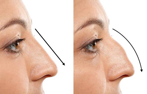 rinoplastia-transformando-la-confianza-y-mejorando-la-respiracion imagen de artículo