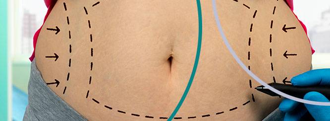 beneficios-de-la-abdominoplastia imagen de artículo