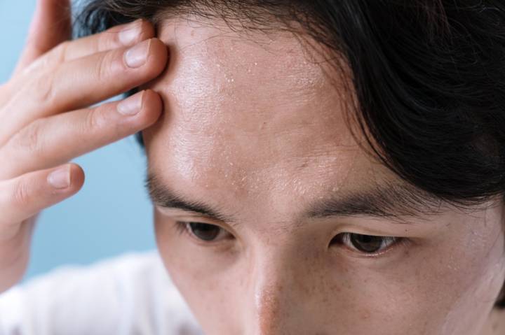 simpatectomia-solucion-para-hiperhidrosis-rubor-facial imagen de artículo