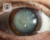 cataratas-en-los-ojos