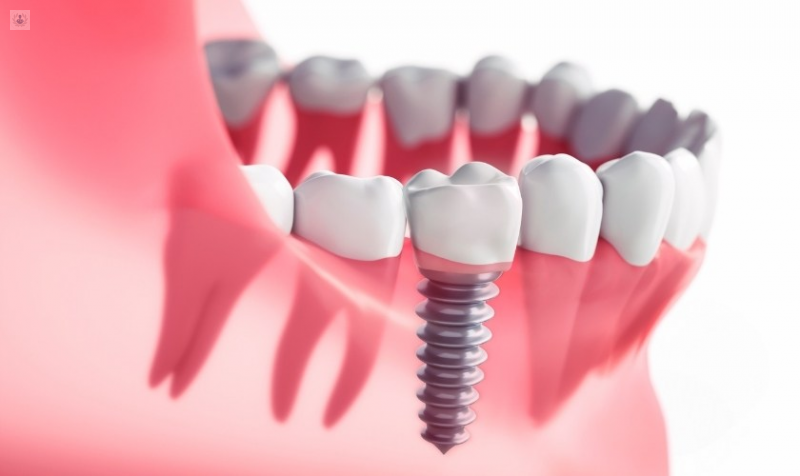 implantes-dentales