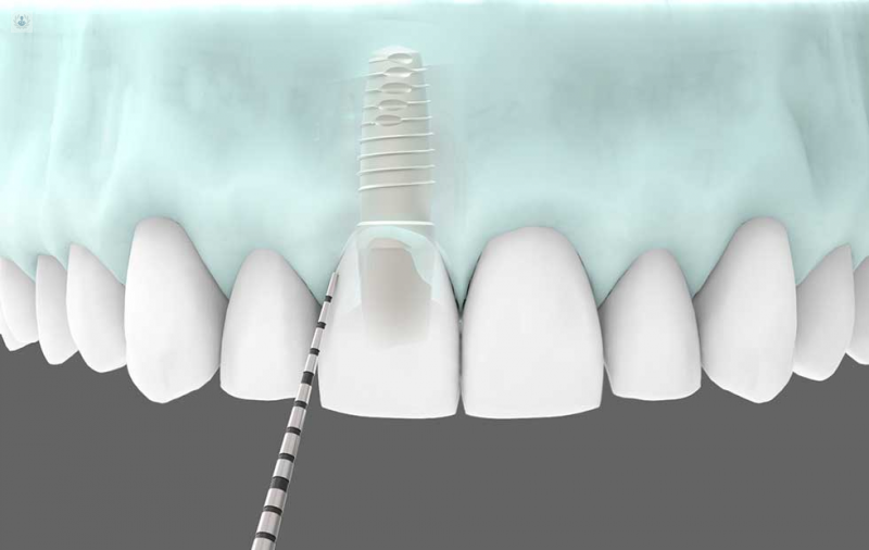 Mantenimiento Implantes Dentales