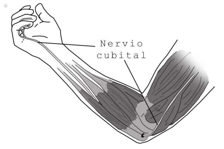 cirugía-nervio-cubital