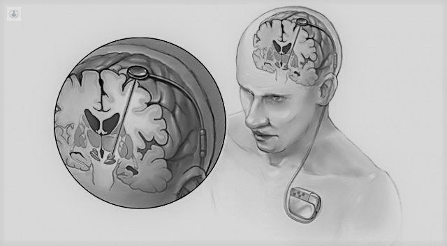 Estimulación Cerebral Profunda