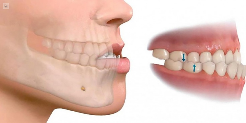Maloclusión Dental