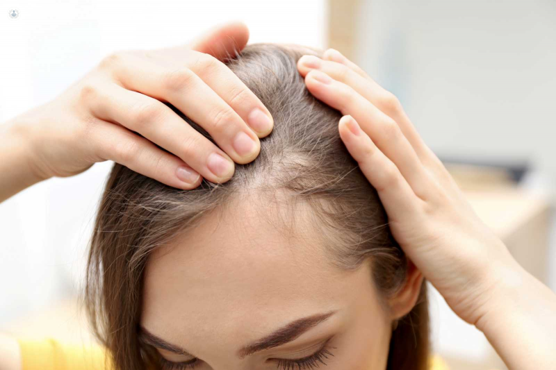 Alopecia femenina