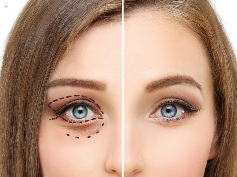 Blefaroplastia