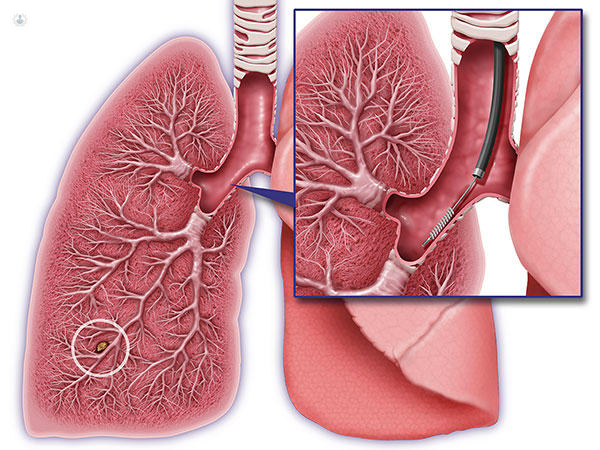 biopsia-pulmonar