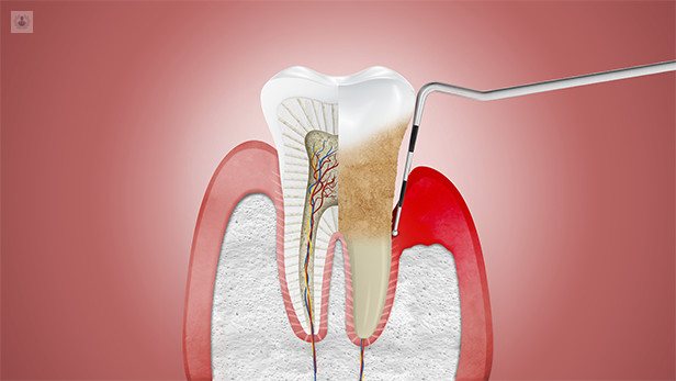 enfermedad-periodontal