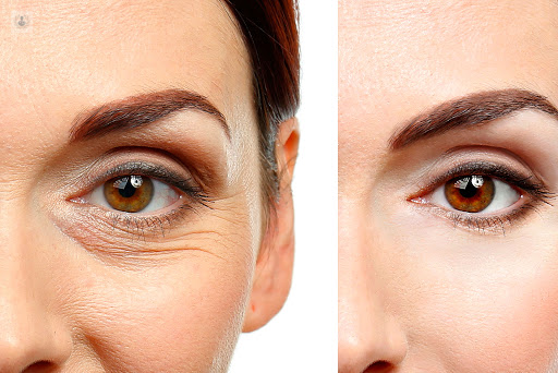 Blefaroplastia