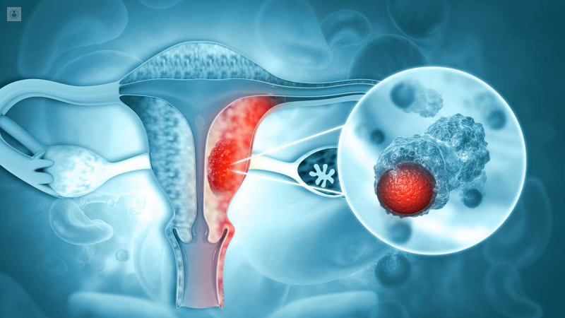cancer-de-cuello-uterino