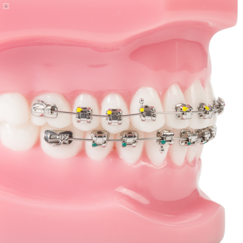 ortodoncia-autoligado