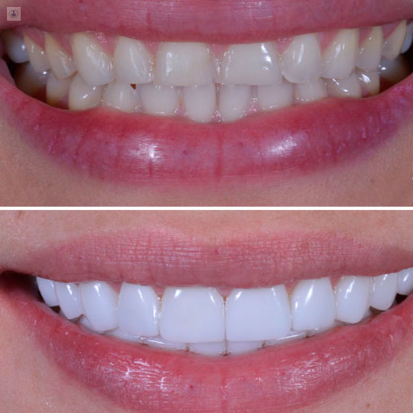 Beneficios de las Carillas Dentales para lucir una bella sonrisa