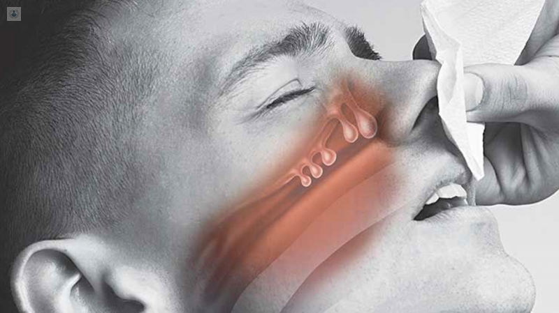 poliposis-nasal