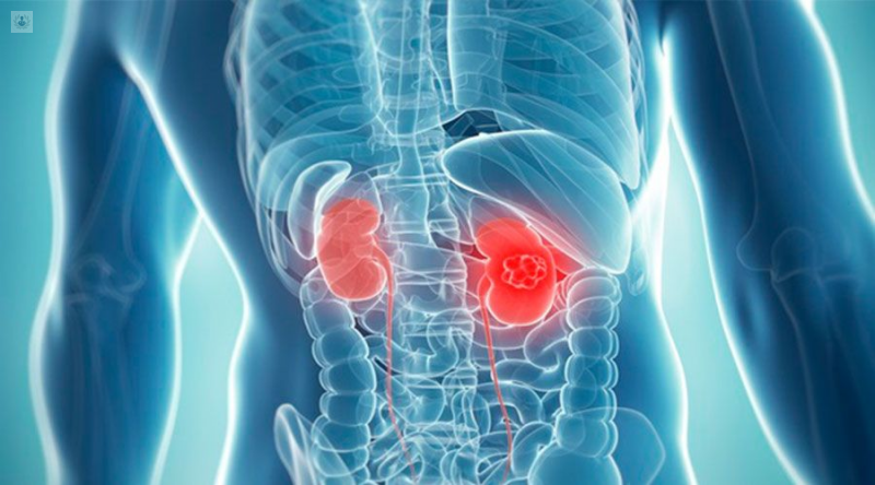 Cáncer Renal