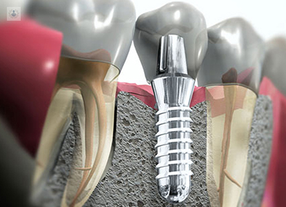 Implantes Dentales