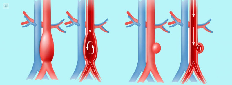 Aneurisma de Aorta