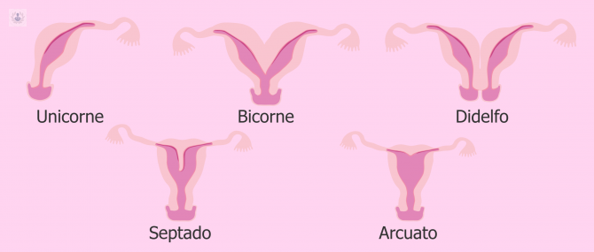 malformaciones-uterinas