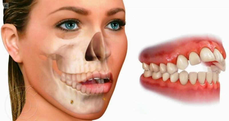 maloclusión-dental