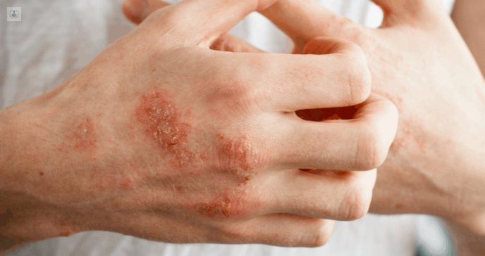 dermatitis-alérgica-por-contacto