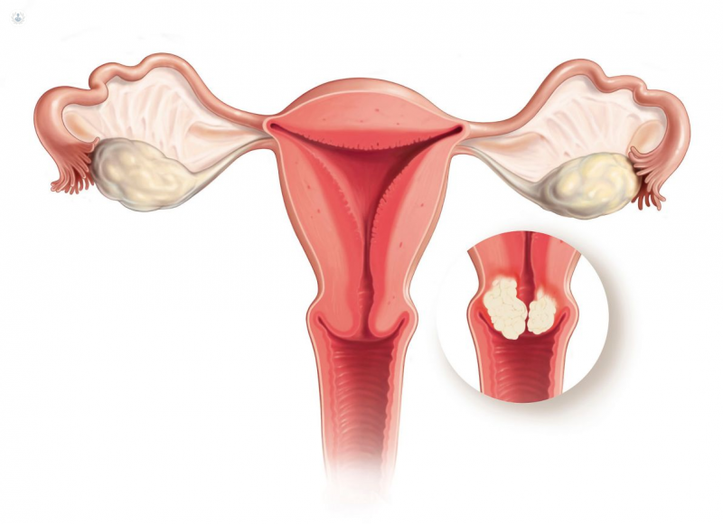 Intervenciones Quirúrgicas para el Cáncer Cervical