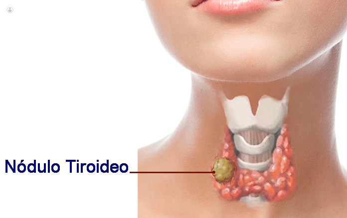 Nódulo Tiroideo 