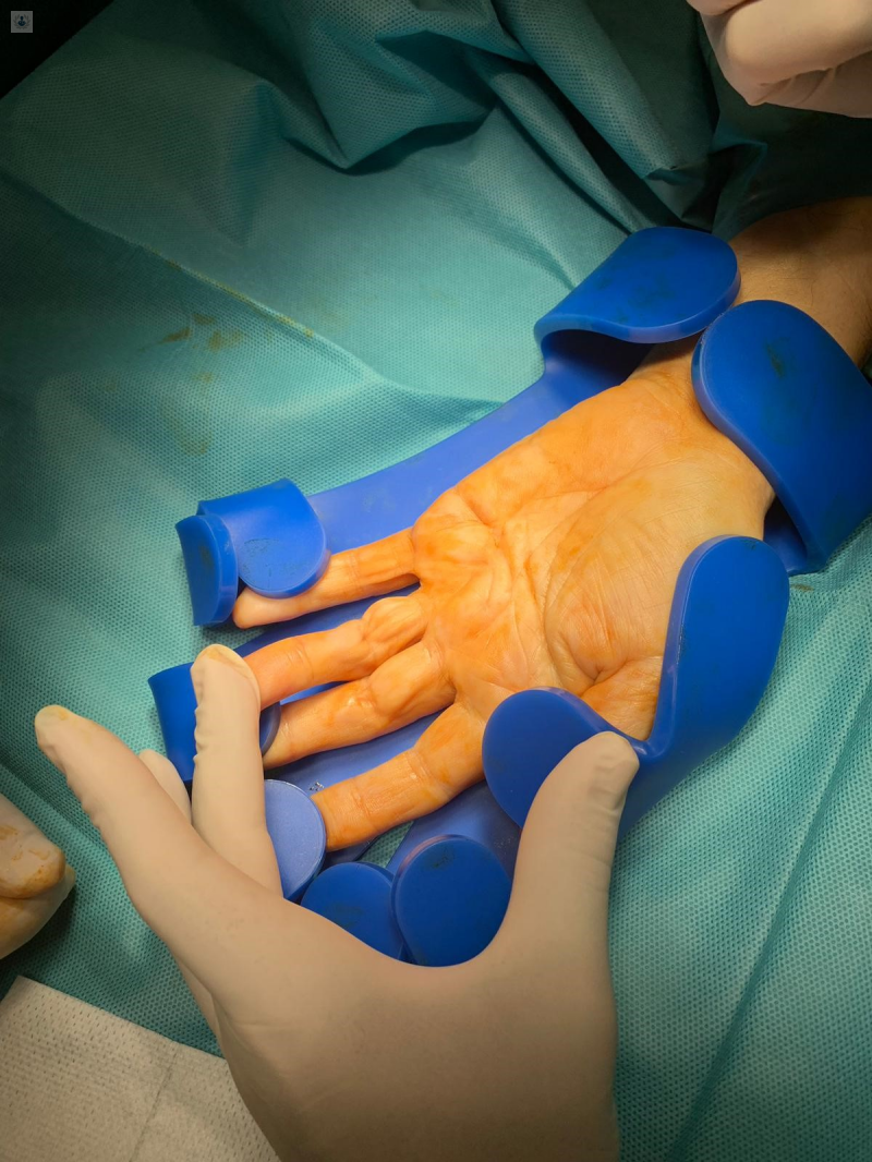 Cirugia de la mano