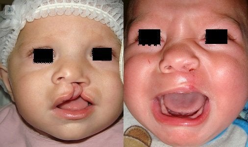 el antes y el después del labio leporino